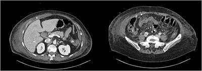 Case Report: Abdominal Wall Abscess as First Clinical Sign of Jejunal Perforation After Blunt Abdominal Trauma